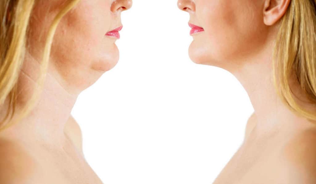 Double Chin treatment King's Lynn before and after results