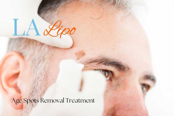 What Are the Most Effective Treatments for Age Spots King's Lynn?