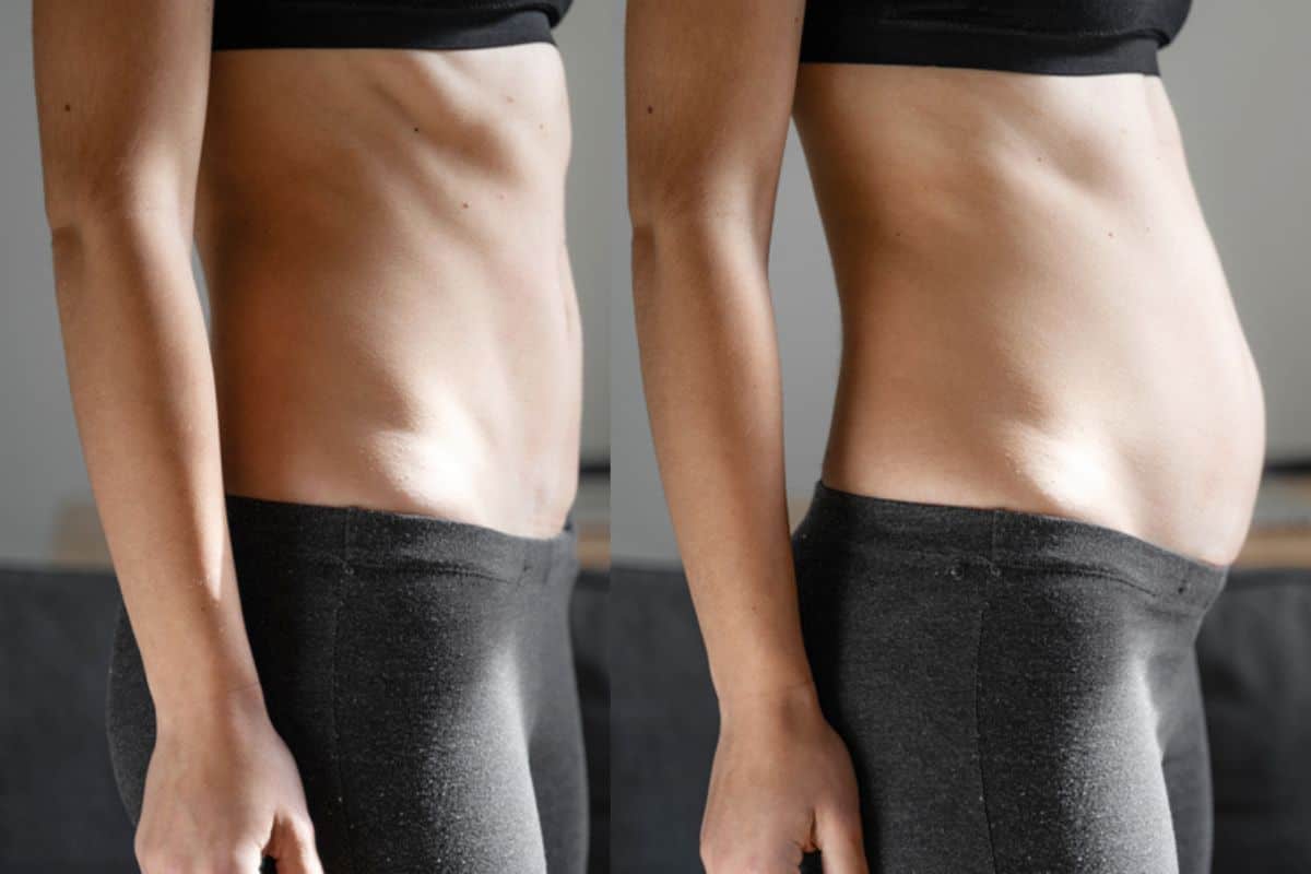 How long does diastasis recti take to improve King's Lynn?