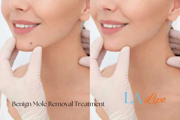 woman's before and after mole removal King's Lynn results