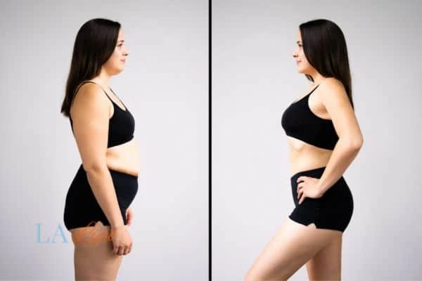 image of woman before and after results of LA-EMS Body Sculpting King's Lynn to help treat Diastasis recti