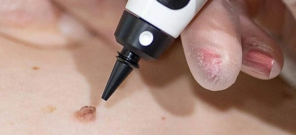 skin tag removal using cryopen King's Lynn