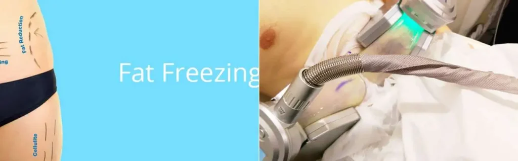 Fat freezing King's Lynn on multiple areas of the body