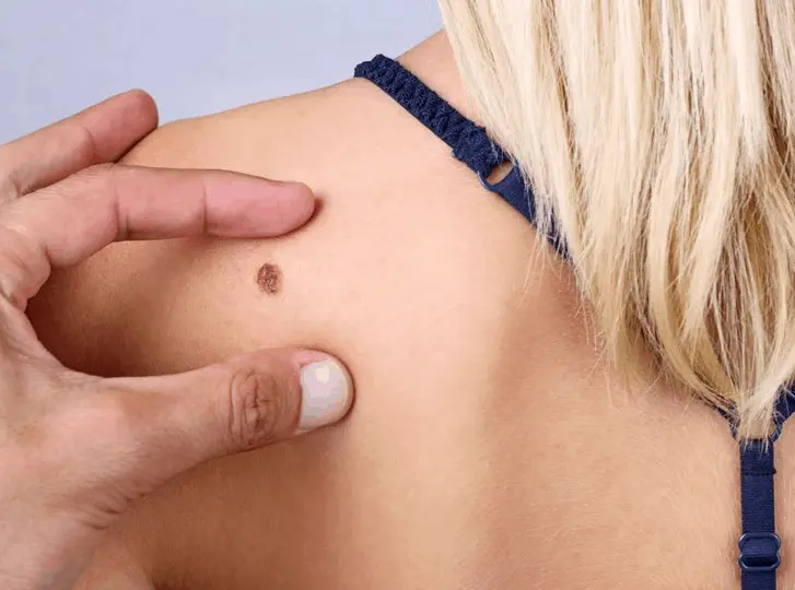woman having mole removal King's Lynn consultation before treatment.