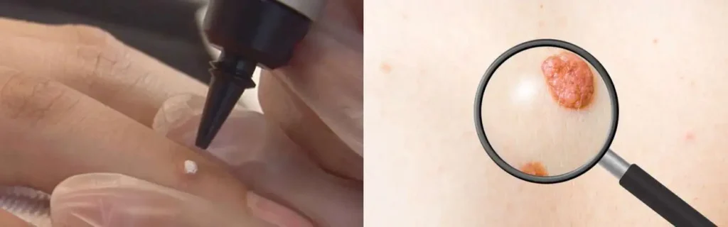 Cryopen for mole removal King's Lynn - speak to our team today!