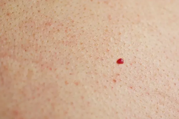 close up of a cherry angioma King's Lynn