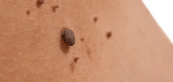 image of a skin tag King's Lynn