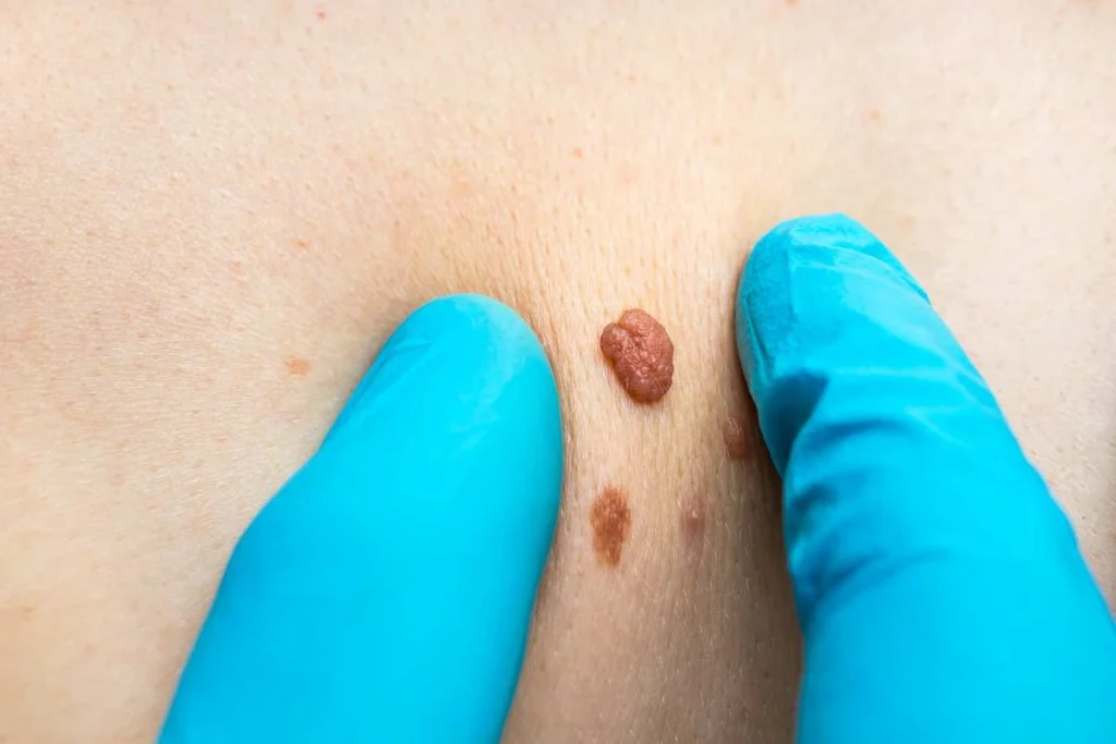 Consultant examining a skin tag King's Lynn