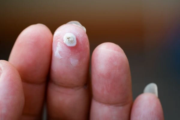 wart on person finger - cryotherapy to treat from LA LIPO King's Lynn