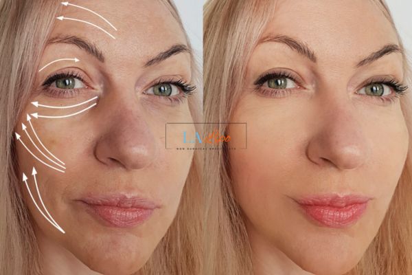 Morpheus 8 results King's Lynn face lift.