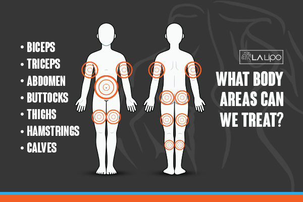 Diagram to show areas you can have LA-EMS Body Sculpting Treatment King's Lynn