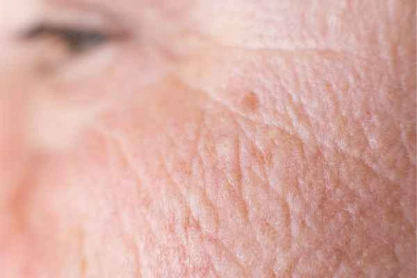 close up picture of a woman's face showing an age spot King's Lynn