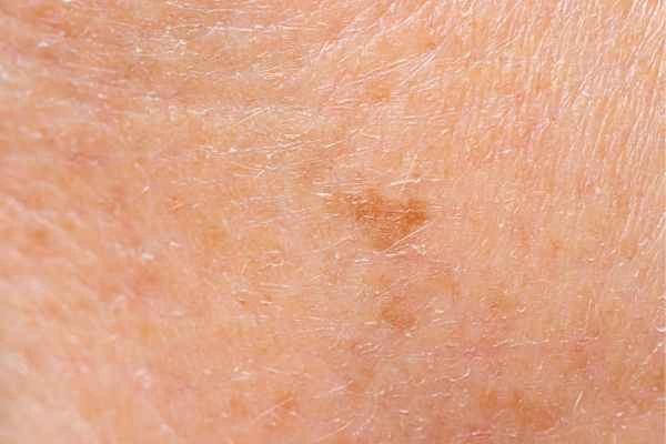 close up picture of age spots King's Lynn