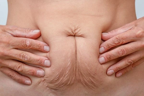 Should I Combine Diastasis Recti Treatment with Body Contouring for Better Results King's Lynn?